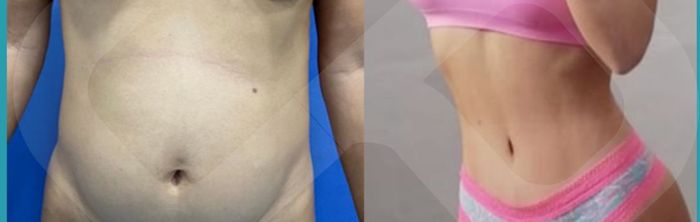 Abdomen antes y después de abdominoplastia HD