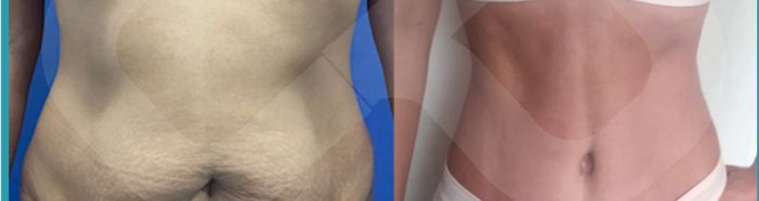 Abdomen antes y después de abdominoplastia HD
