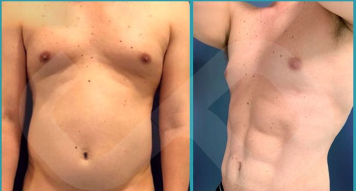 Torso masculino antes y después de Fit Lipo