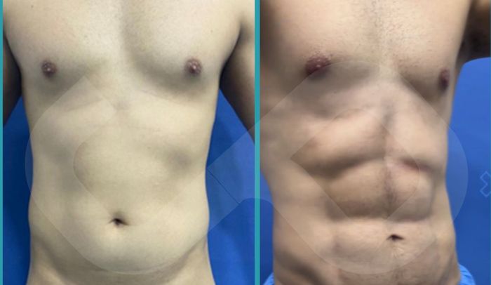 Torso masculino antes y después de Fit Lipo